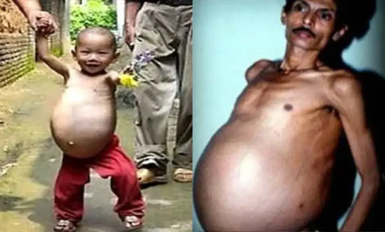 شاب هندي عاش حياته تعيسا… ما علاقة توأمه؟