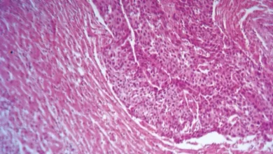 تقنية جديدة لعلاج سرطان الرئة