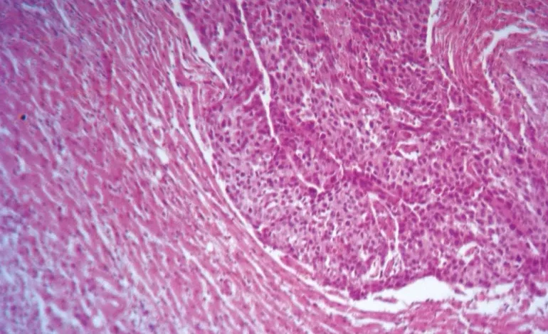 تقنية جديدة لعلاج سرطان الرئة