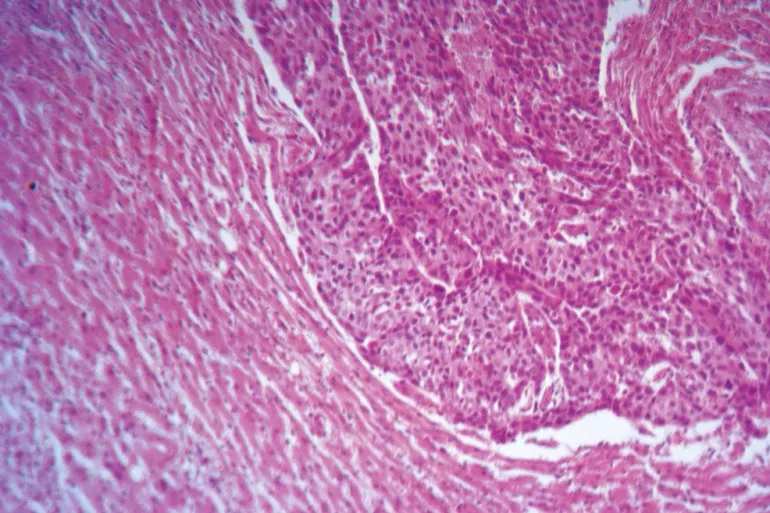 تقنية جديدة لعلاج سرطان الرئة