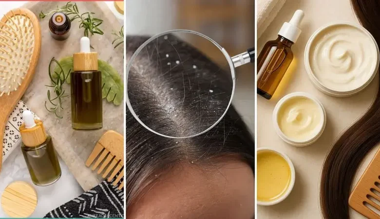 القضاء على قشرة الشعر ممكن بأساليب طبيعية وعمليّة