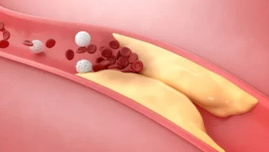 كيف يمكن خفض الكوليسترول في الدم دون أدوية؟