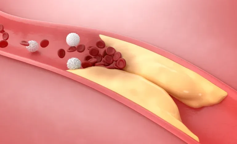 كيف يمكن خفض الكوليسترول في الدم دون أدوية؟