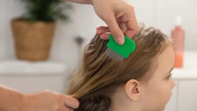 3 خطوات للتخلص من القمل