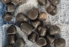 بالصورة: استخراج 58 حصوة من كلية مريض