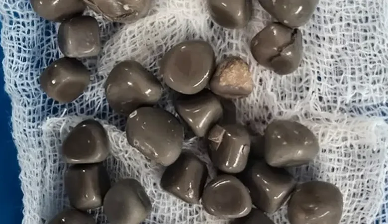 بالصورة: استخراج 58 حصوة من كلية مريض