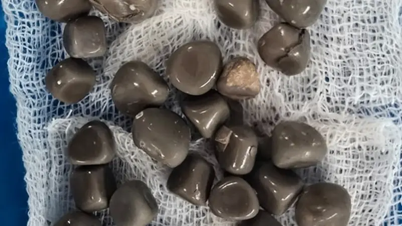 بالصورة: استخراج 58 حصوة من كلية مريض