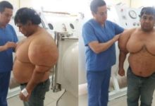 غواص بيروفي "منتفخ" يعاني تورما غير مسبوق