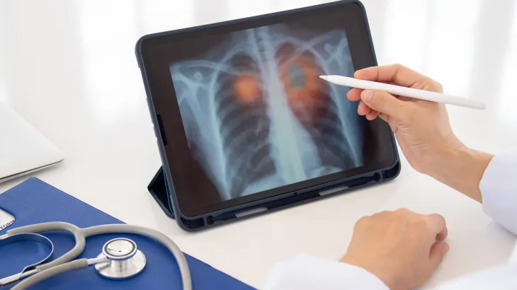 خبراء: سرطان الرئة قابل للعلاج والنجاة