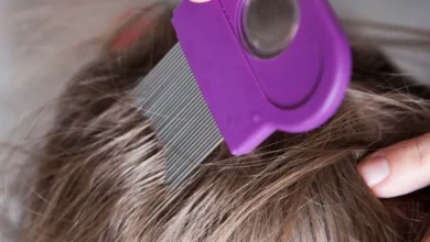 ما هي أعراض ‫فطريات فروة الرأس؟