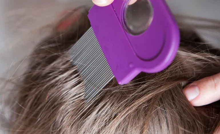 ما هي أعراض ‫فطريات فروة الرأس؟