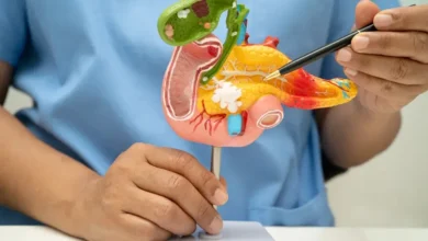 إنجاز إسباني يفتح باب الأمل لعلاج سرطان البنكرياس